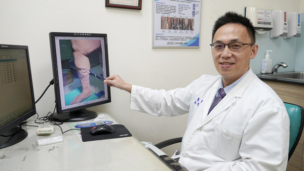 【東森新聞網】靜脈曲張怎麼辦？　中壢天晟：治療停看聽謹記六要點