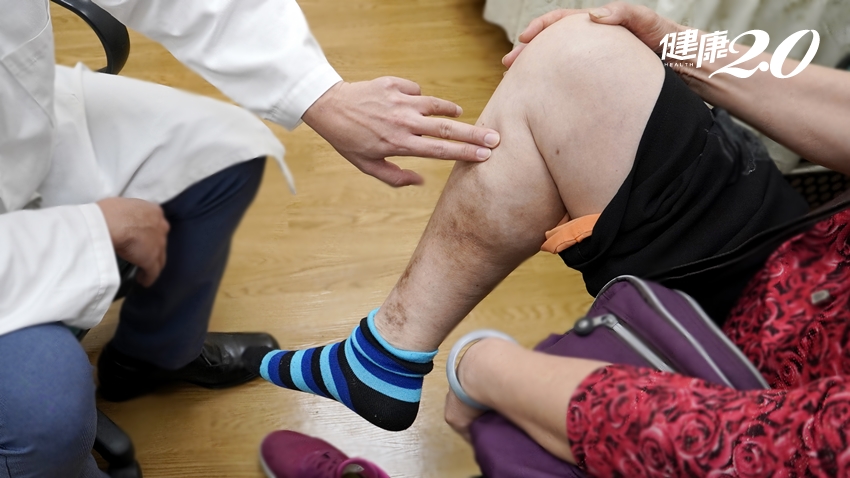 小腿靜脈曲張浮青筋…雷射手術一勞永逸？治療前你該了解4件事 王家瑜 報導