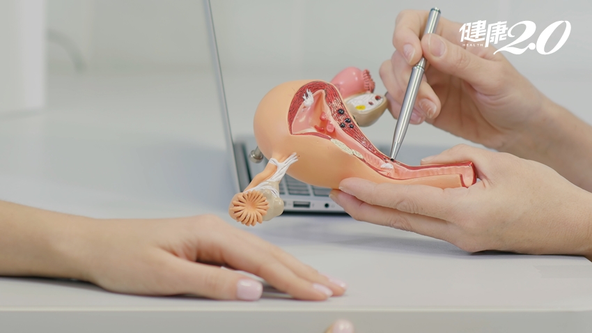 【TVBS】「子宮內膜瘜肉」要趁早攔截、以免變癌！1種方式能安全切除