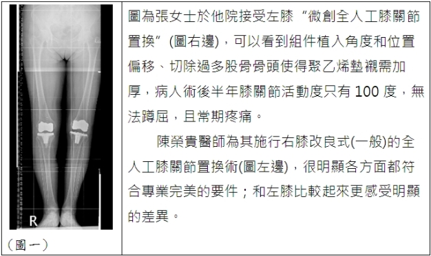 微創全人工膝關節置換手術之迷思